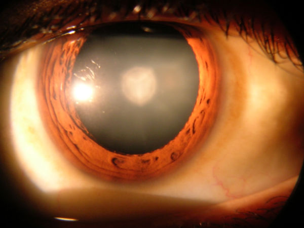 Cataract 