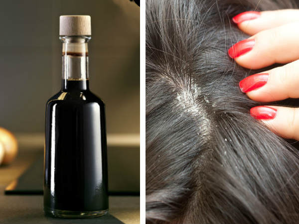 Vinegar For Dandruff