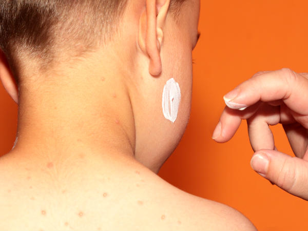 classic chicken pox symptoms you should know about