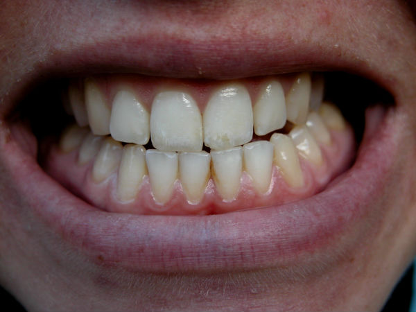  Bruxism: Do you grind your teeth when asleep?
