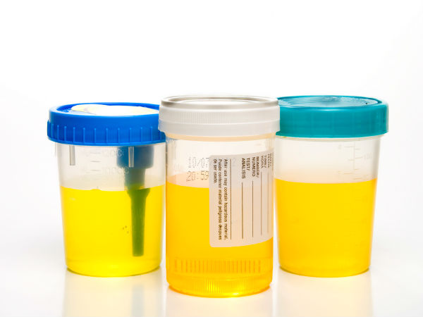  What Does Your Urine Colour Indicate?