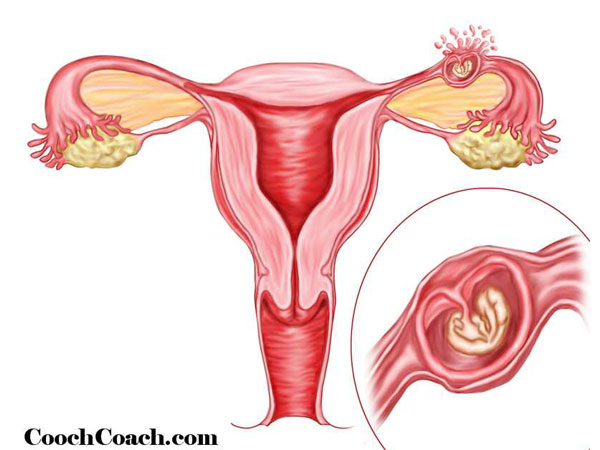 एक्टोपिक प्रेगनेंसी