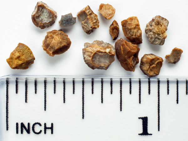 किडनी स्‍टोन से बचाए 