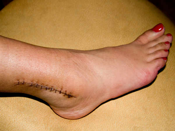 ऑपरेशन के बाद