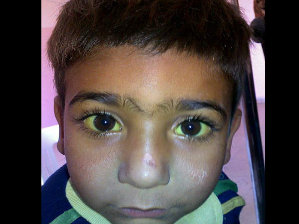 एंटी मलेरिया गुण 