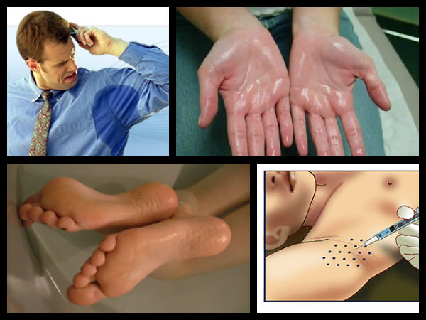 बहुत ज्‍यादा पसीना 