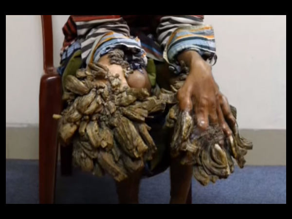  किस चीज़ की वजह से होती है ये बीमारी 