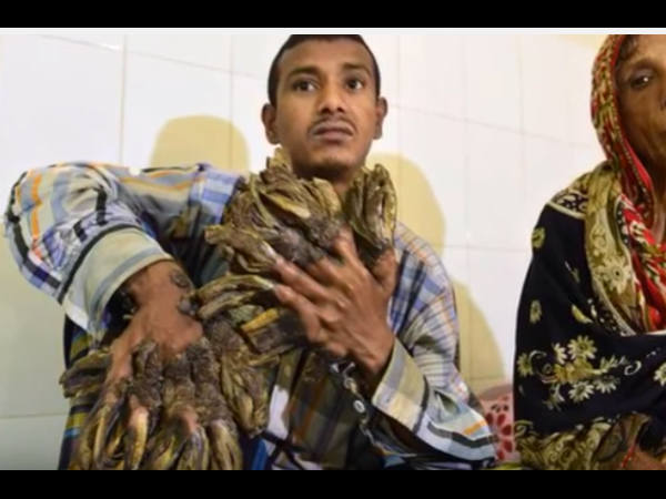 6 महीनों तक चल सकता है इलाज