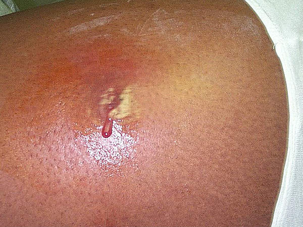 7. एमआरएसए इन्फ़ैकशन