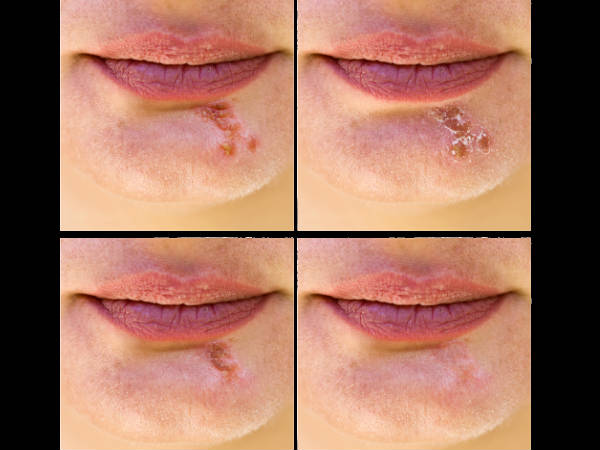 best-home-remedies-for-herpes best-home-remedies-for-herpes