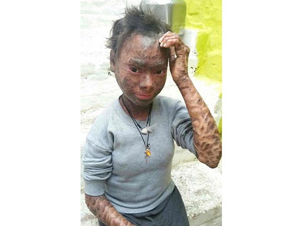 1. इस स्थिति को अर्थ्रोडर्मा कहते हैं 1. इस स्थिति को अर्थ्रोडर्मा कहते हैं