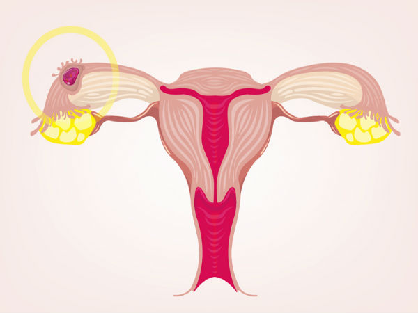 8. आस्थानिक (एक्टोपिक) प्रिग्नेंसी 