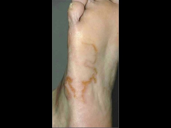 hook worm found in a man’s foot
