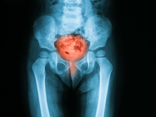 अ. गर्भाशय और शरीर के अन्य अंगों पर निशान वाला ऊतक: