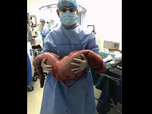  Chinese Surgeons Remove 30 Inches of Man’s Intestines to Relieve Painful Constipation 2 