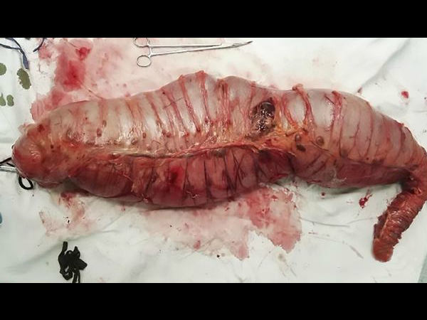 Chinese Surgeons Remove 30 Inches of Man’s Intestines6 