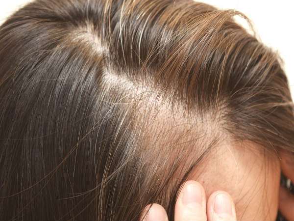 हेयर फॉल रोकने के लिये 