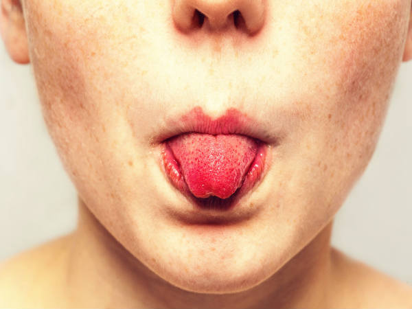 मुंह के छालों से आराम