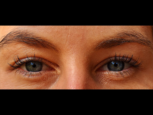 प्रोट्रूडिंग आंखें