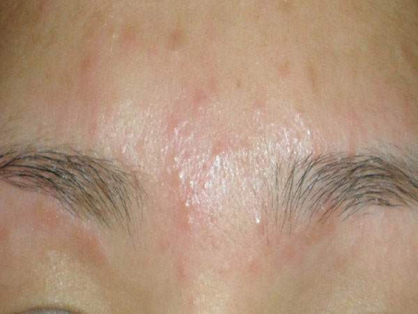 थ्र‍ेडि़ग के बाद पिंपल से बचने के उपाय