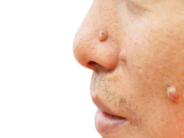 3. मस्‍से से छुटकारा 