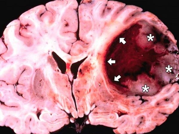 क्‍या है जीबीएम? 