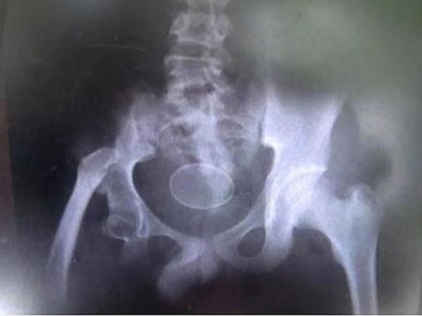 एक्‍स रे तक में दिखाई दिया अंडा 