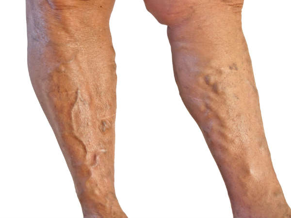 What Are Varicose Veins? Symptoms, Causes & Prevention