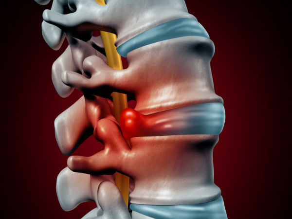 क्‍या होती है बल्‍जिंग डिस्‍क?