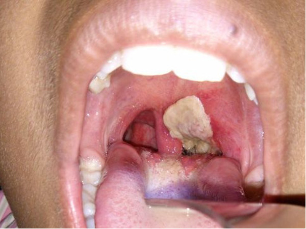  कैसे बनती है डिप्थीरिया में झिल्ली 