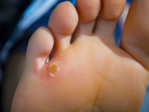 फुट कॉर्न