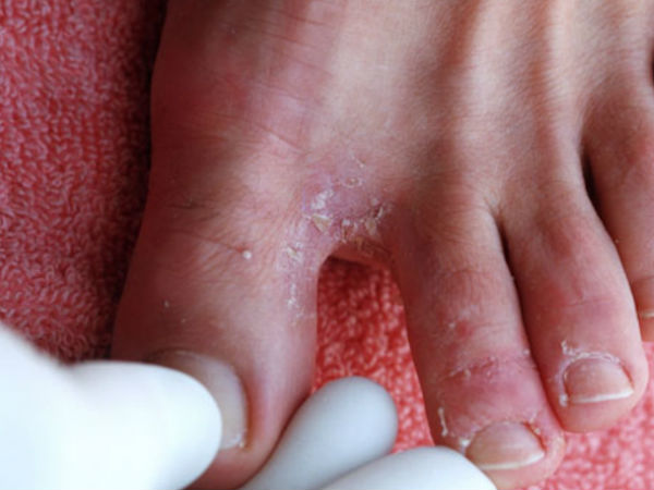 एथलीट फुट