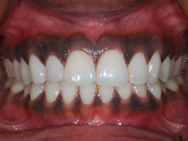 मेलानिन