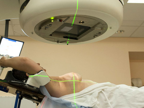 विकिरण या रेडिएशन थेरेपी 