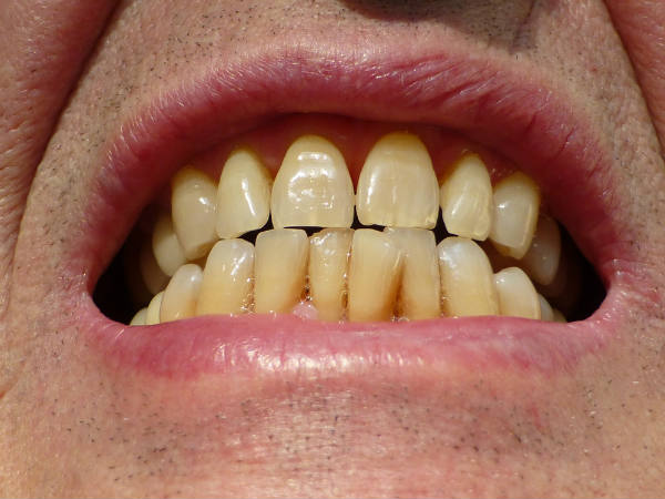  प्यूट्ज़-जेगर्स सिंड्रोम (Peutz-Jeghers Syndrome)