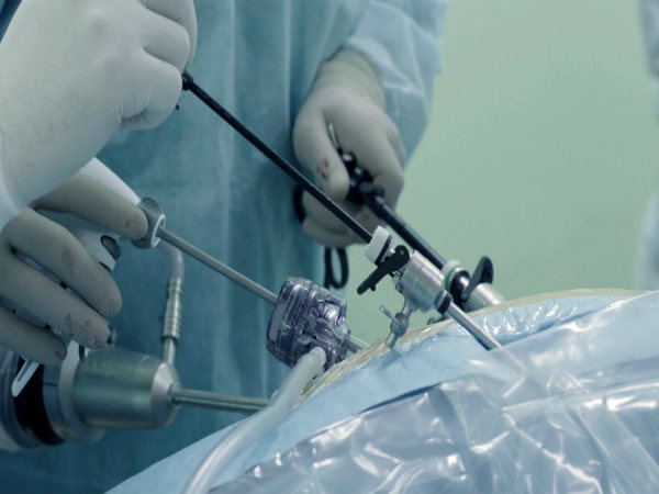 लेप्रोस्‍कोपिक तकनीक