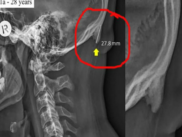 Horns Are Growing on Young Peoples Skulls Due to Phone Use: Research