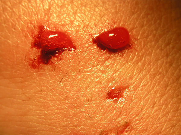 72 घंटे से ज्‍यादा होने पर हो सकता है इंफेक्‍शन