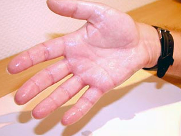 हो सकता है हाइपरहाइड्रोसिस