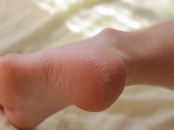 फटी एड़ियों के लिए घरेलू पेडिक्योर