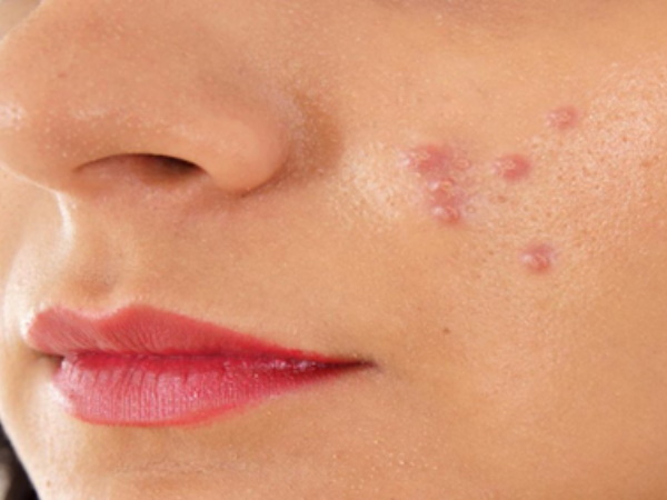 कील- मुंहासे