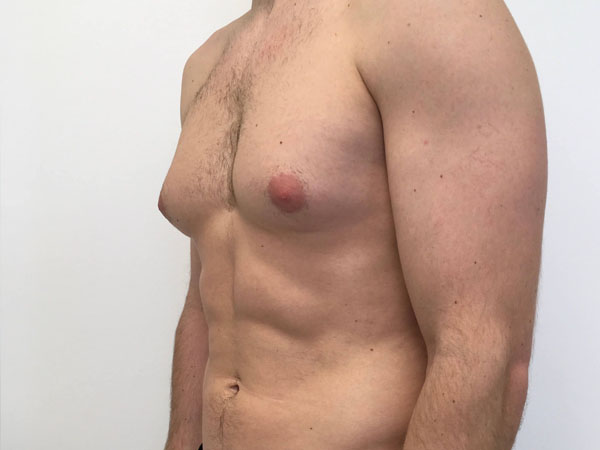 गाइनेकोमैस्टिया