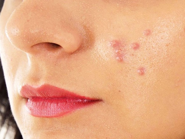 मुंहासे से निजात