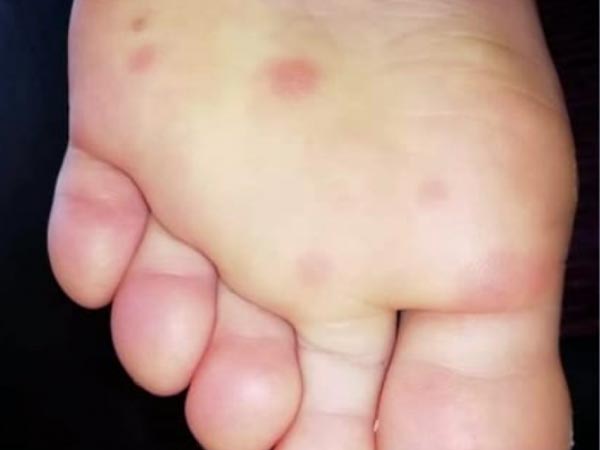 पांव में बैंगनी रंग का घाव