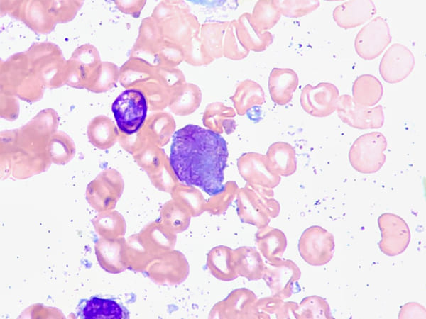 क्रोनिक ल्यूकेमिया-