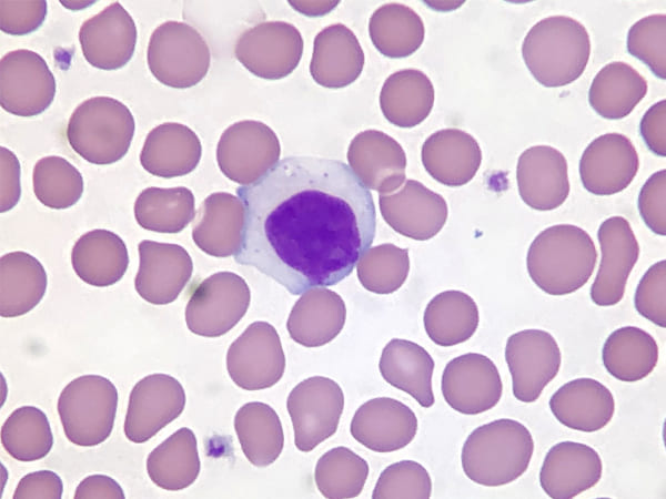  मायलोजनस ल्यूकेमिया-