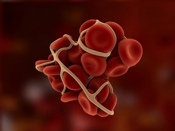 हीमोफीलिया ए के कारण