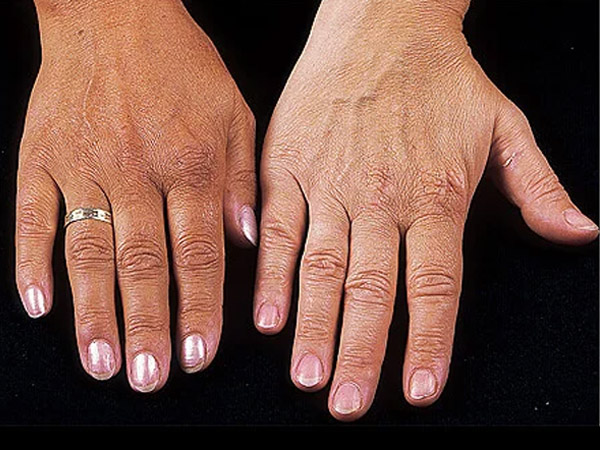 रोग के लक्षण