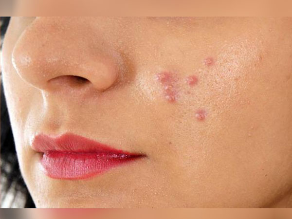 पिंपल से राहत पिंपल से राहत