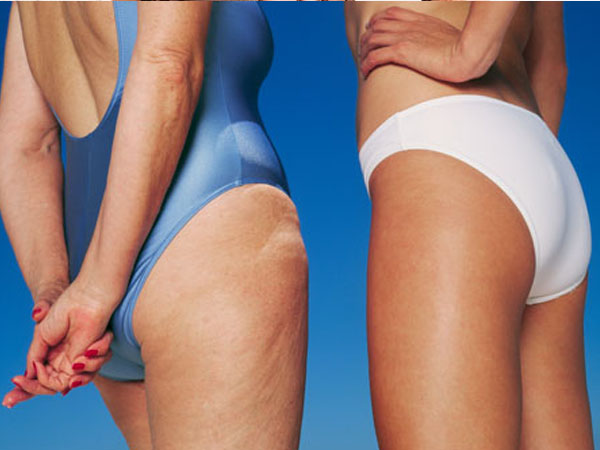 क्यों होता है सैल्यूलाइट